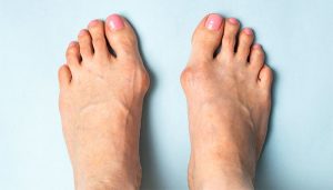 هالوکس والگوس چیست؟