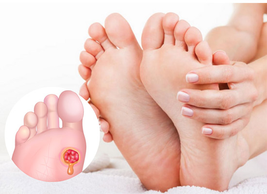 نقش اسکن کف پا در درمان زخم‌ های دیابتی