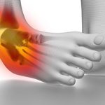 مچ بند پا برای پیچ خوردگی