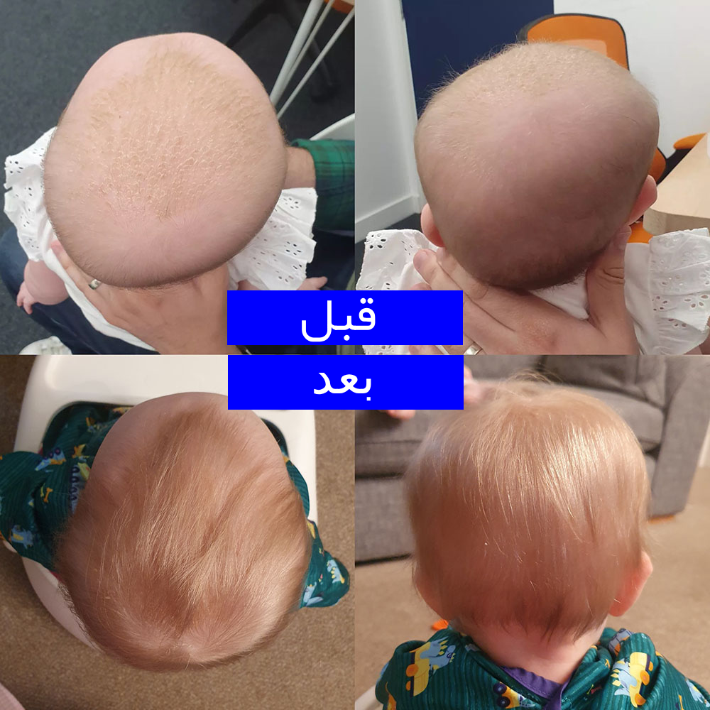 عکس قبل و بعد استفاده از کلاه فرم دهی سر نوزاد