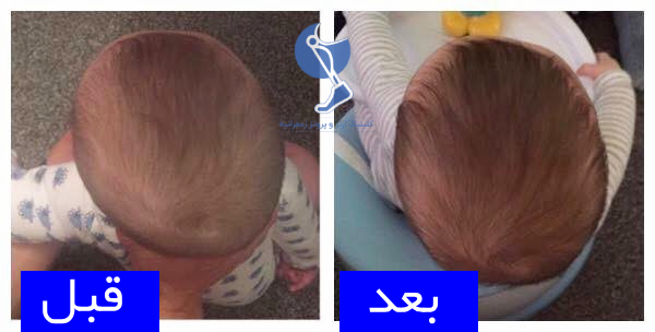 بعد و قبل استفاده از ارتز کرانیال و کلاه طبی سرنوزاد