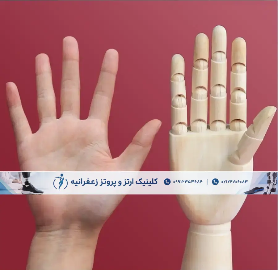 پروتز مچ دست