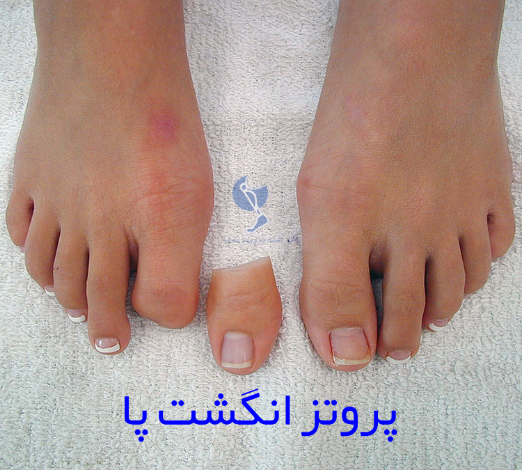پروتز انگشت شست پا