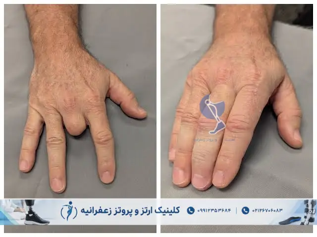 پروتز انگشت دست