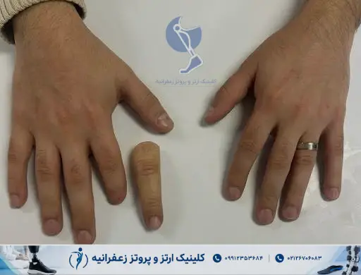 پروتز انگشت دست