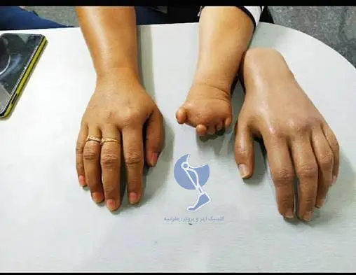 پروتز دست در تهران