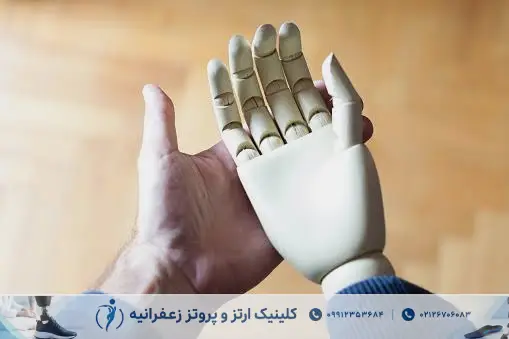 پروتز مچ دست چیست