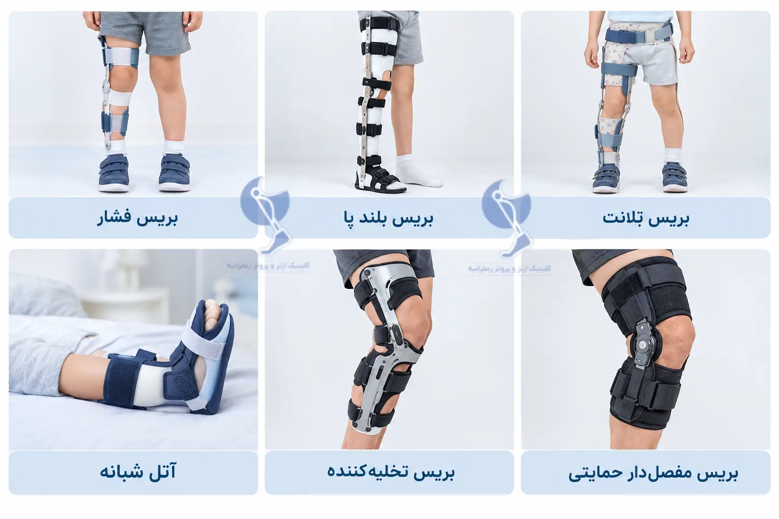 انواع بریس پای پرانتزی