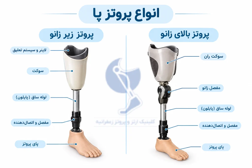 انواع پروتز پا براساس ناحیه قطع عضو