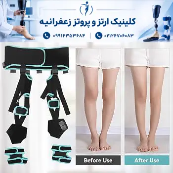 عکس قبل و بعد درمان پای پرانتزی در بزرگسالان با بریس