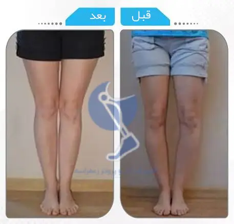 عکس قبل و بعد درمان پای پرانتزی در بزرگسالان با بریس