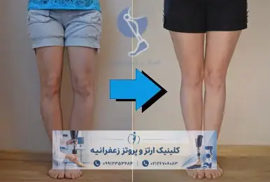 عکس قبل و بعد درمان پای پرانتزی در بزرگسالان با بریس