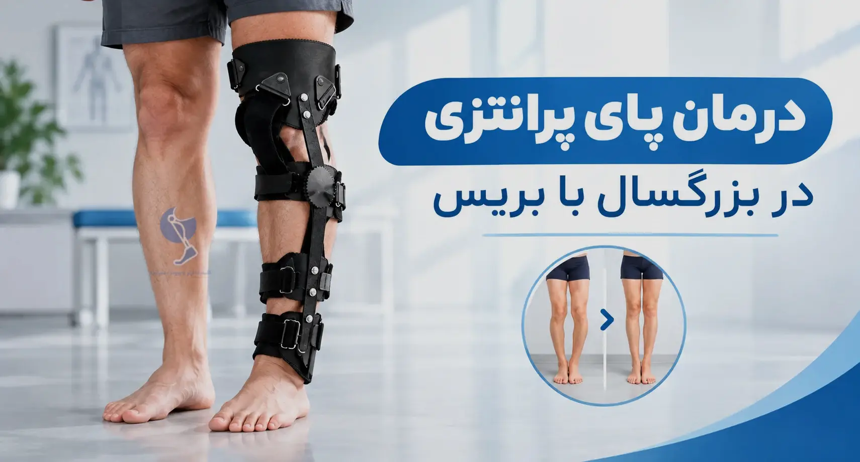 درمان پای پرانتزی در بزرگسالان با بریس