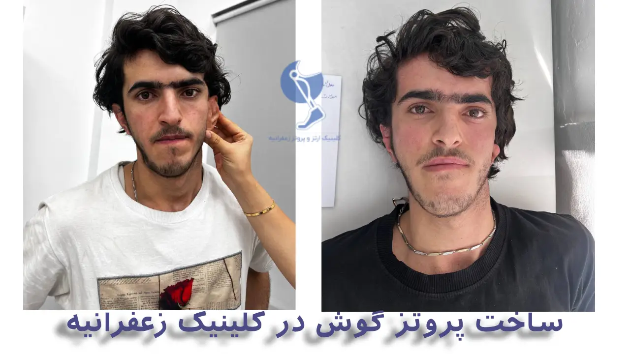 عکس قبل و بعد ساخت پروتز گوش در تهران
