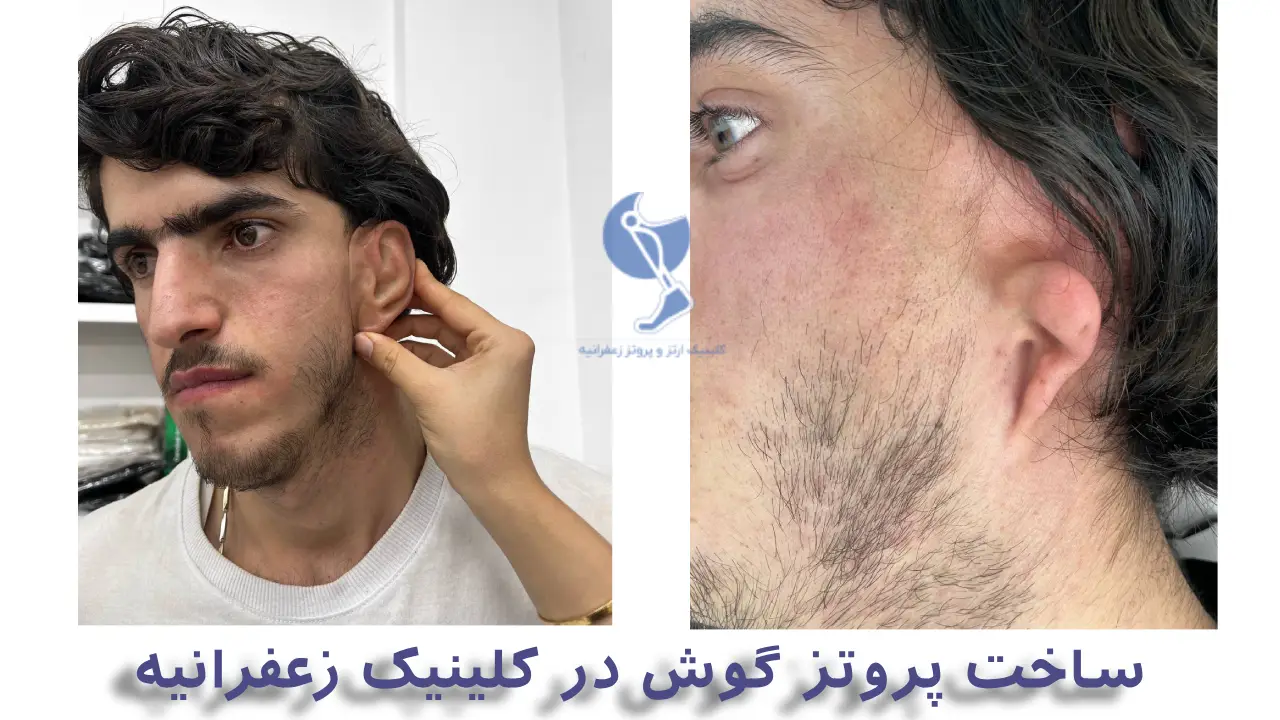 عکس قبل و بعد ساخت پروتز گوش در تهران