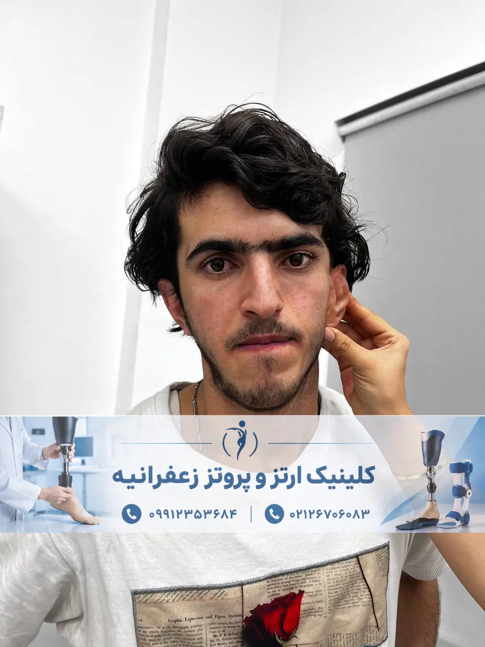 نمونه ساخت پروتز گوش در تهران