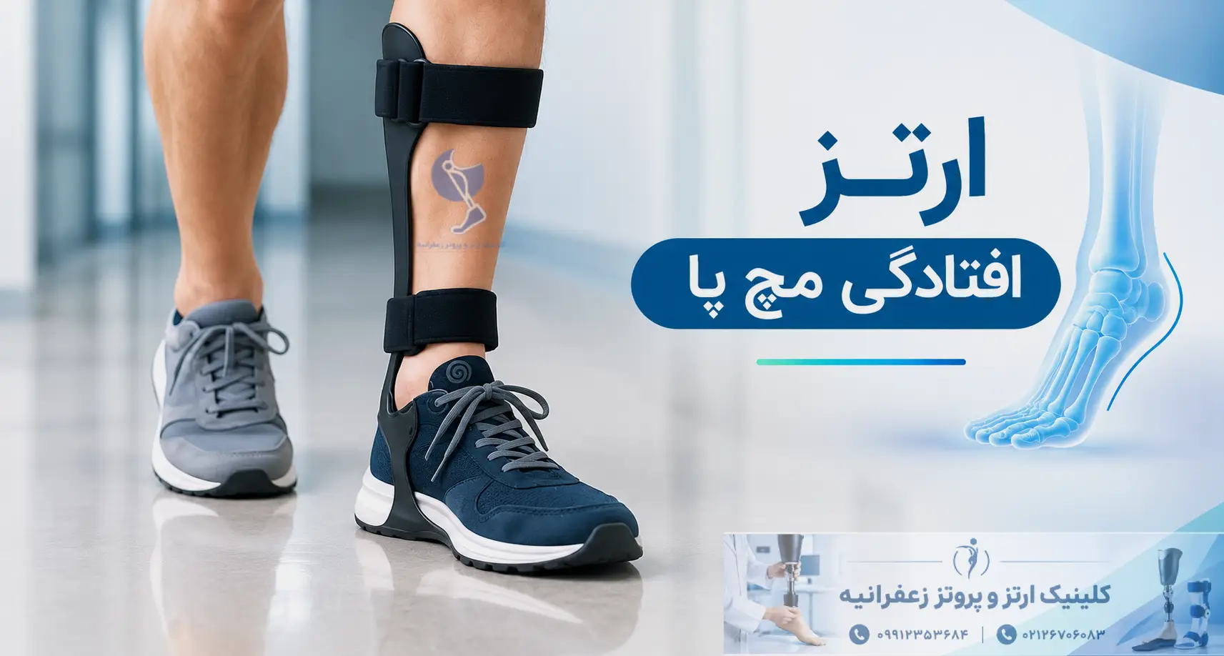 ارتز افتادگی مچ پا چیست؟
